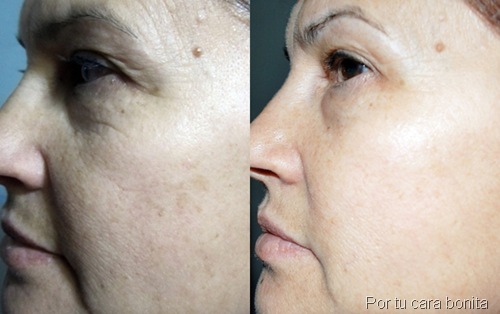 antes y despues tratamiento kit sos cosmetics27 antes y despues tratamiento kit sos cosmetics27