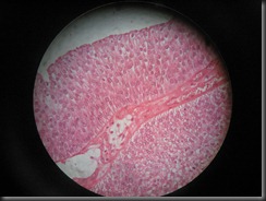 Urothelial ca high resolution histology slide tsnaps Urothelial ca high resolution histology slide tsnaps