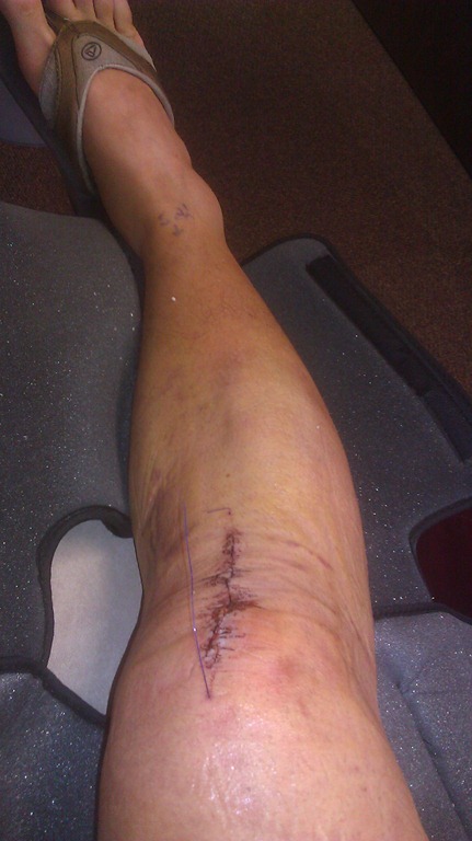 [acl_post_op_stiches%255B2%255D.jpg]