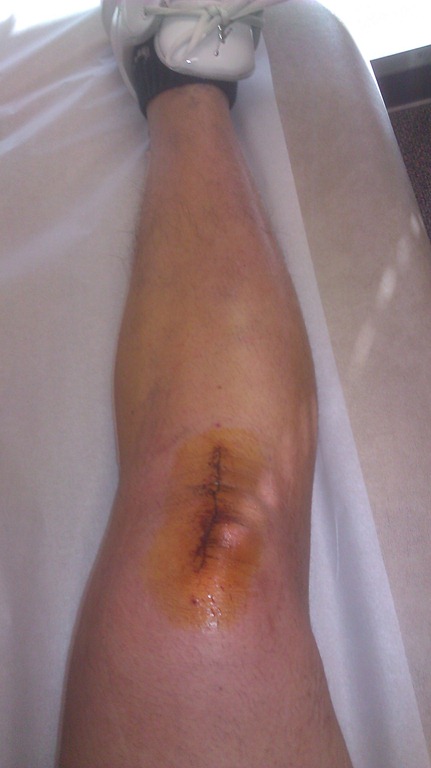 [acl_post_stiches_out%255B3%255D.jpg]
