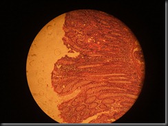 Adenoma Colon high resolution histology slide tsnaps Adenoma Colon high resolution histology slide tsnaps