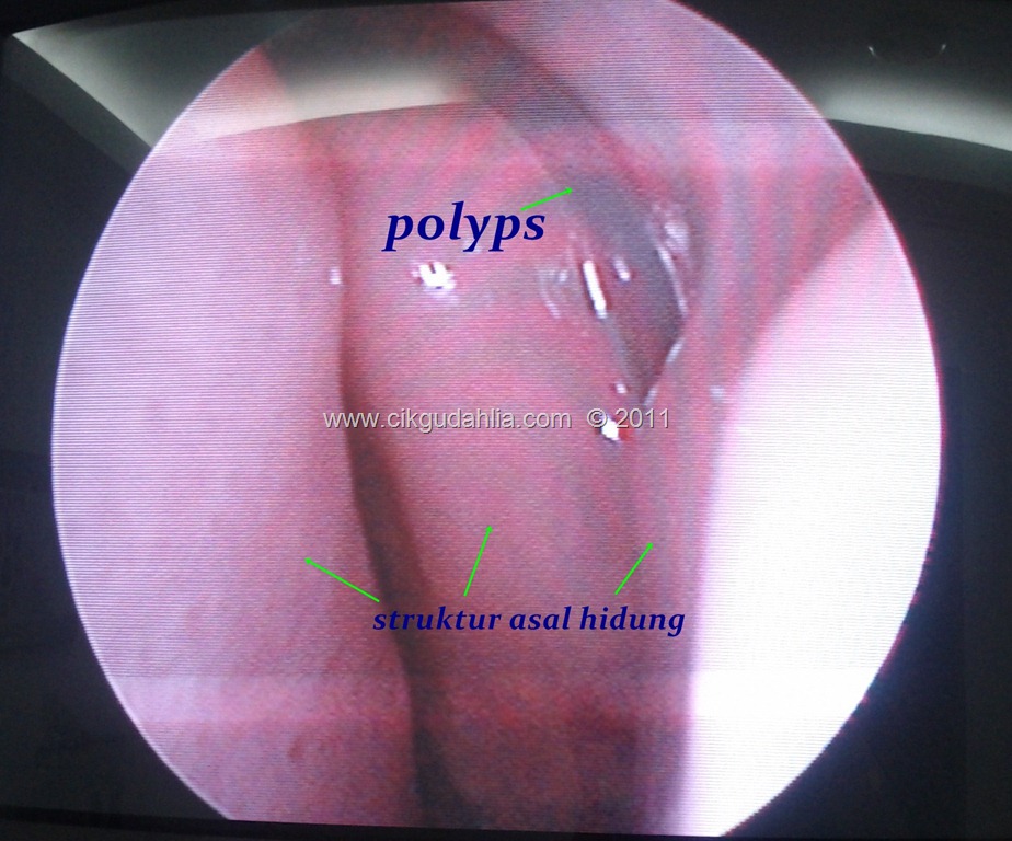 [polyps%2520dalam%2520hidung%255B12%255D.jpg]