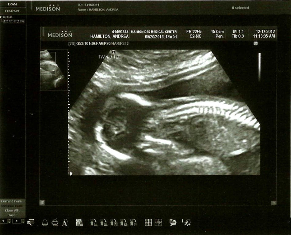 [Twin%2520B%2520Baby%2520Boy%2520Spine%252018%2520Weeks%255B3%255D.jpg]