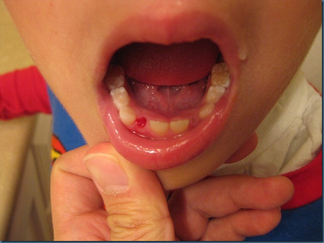 missing_tooth1