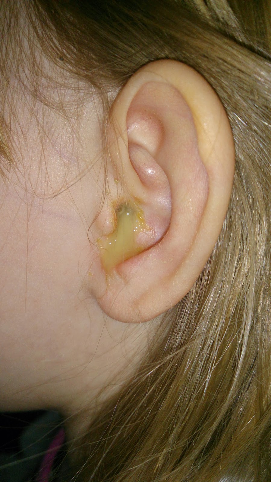 öroninflammation blod i örat