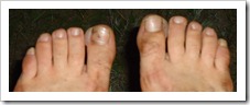 Blisters2 Blisters2