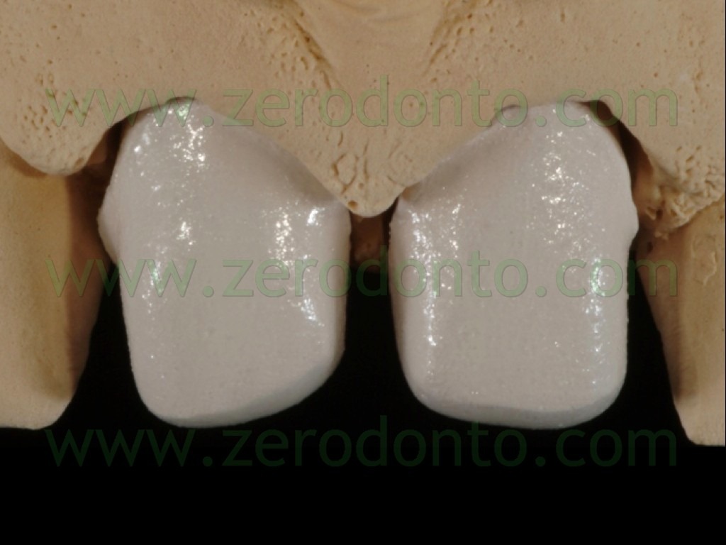 [88-stratificazione-ceramica-faccette%255B2%255D.jpg]
