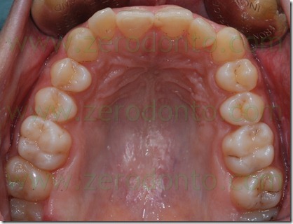 5 occlusale superiore malocclusione di seconda classe 5 occlusale superiore malocclusione di seconda classe