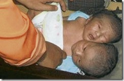 Bayi Berkepala Dua Di Indonesia