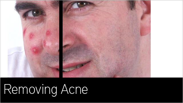 Removing-Acne-In-Photoshop