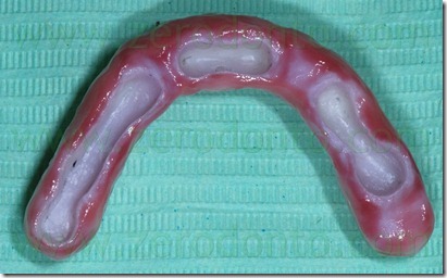 zirconia core