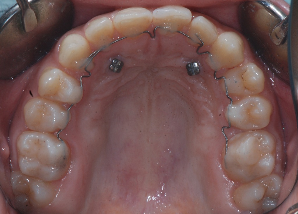 [34b%2520retainer%2520attivo%255B3%255D.jpg]