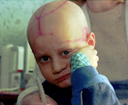 Alec Ahlob de cinco años de edad que sufre de leucemia es atendido por su médico en el Hospital Regional Infantil de Cáncer de Gomel en Belarús. Su cabeza muestra los procedimientos médicos a marzo 19 del 1996 Alec Ahlob de cinco años de edad que sufre de leucemia es atendido por su médico en el Hospital Regional Infantil de Cáncer de Gomel en Belarús. Su cabeza muestra los procedimientos médicos a marzo 19 del 1996