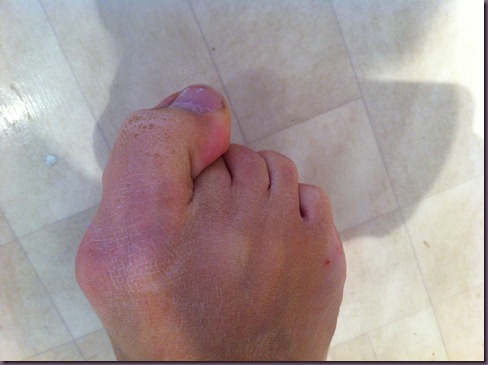 hallux valgus3 hallux valgus3