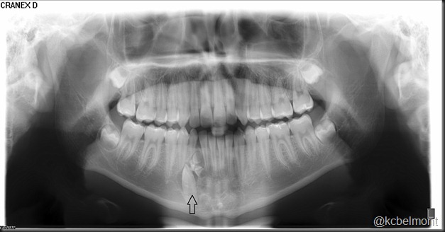 odontoma composto