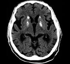 Ct+scan+of+brain+with+dementia