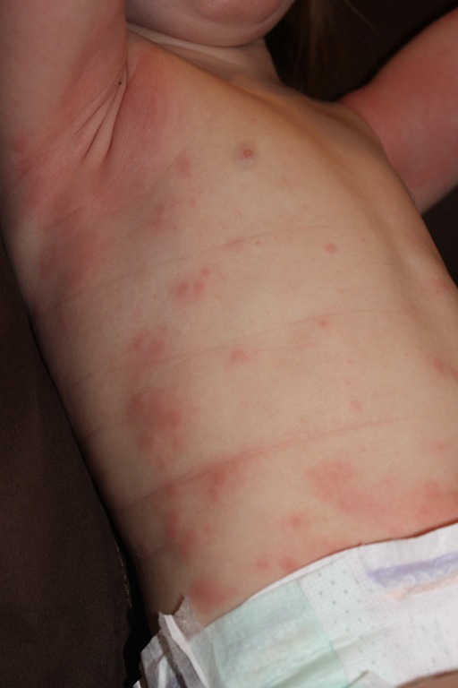 [2012-02-07%2520Hives%25208%255B4%255D.jpg]