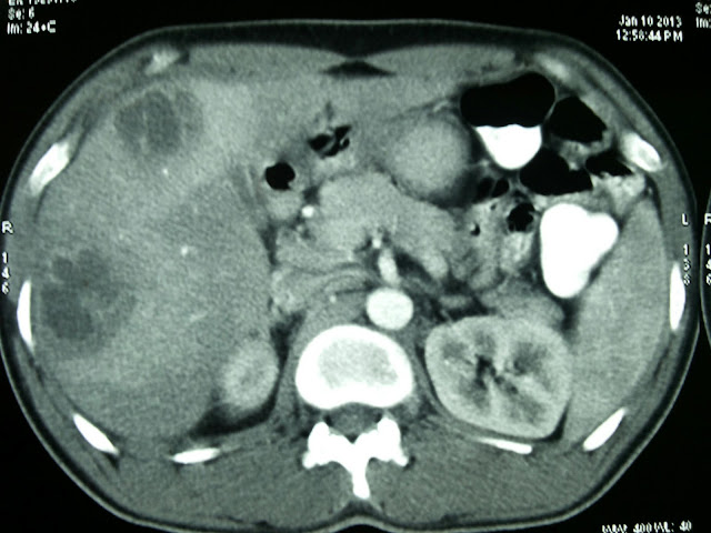 ct scan pyogenic liver abscess