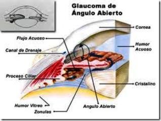Glaucoma de angulo abierto
