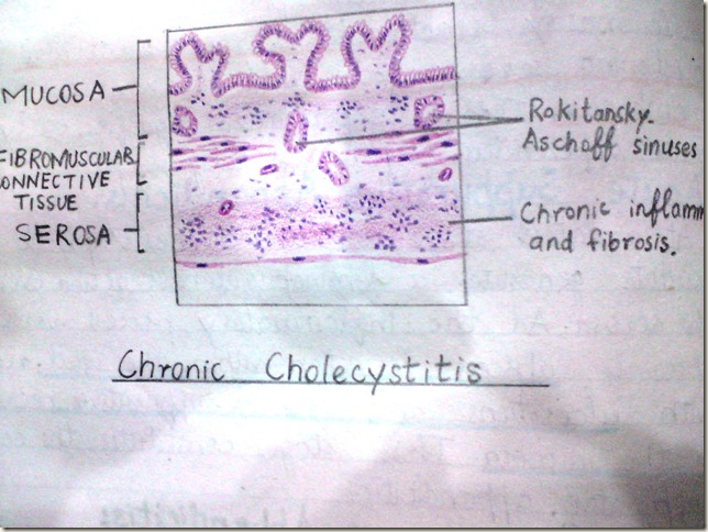 chronic cholecystitis diagram histopathology