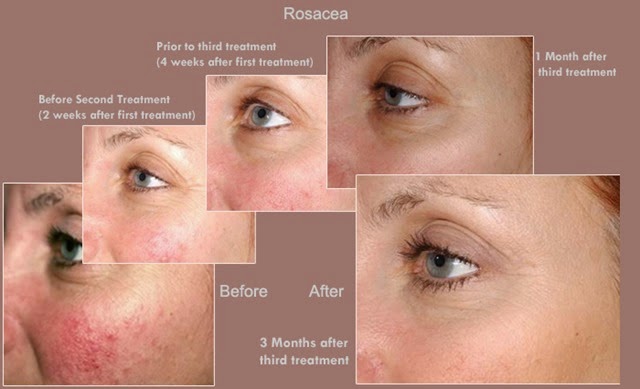 [Causes-and-treatment-of-rosacea%255B2%255D.jpg]