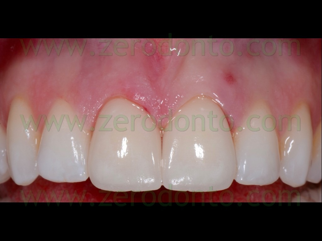[103-try-in-faccette-ceramica3.jpg]