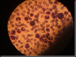 Chronic Myeloid Lukemia high resolution histology slide tsnaps