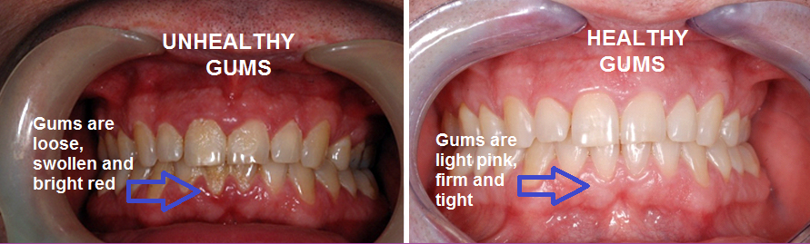 [holly-made-gum-disease1%255B4%255D.png]