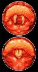 [laryngospasm%255B3%255D.jpg]