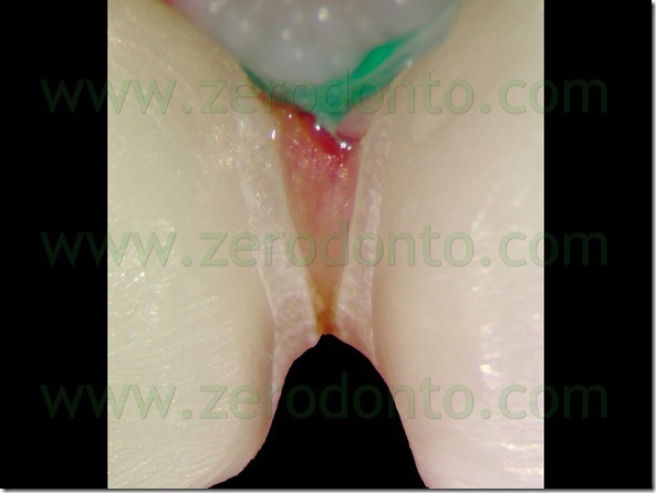 70 preservazione papilla faccette