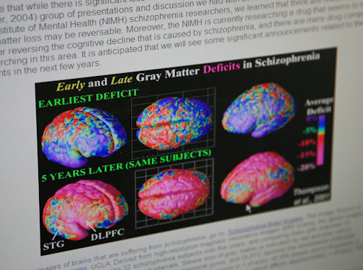 These images show the difference between five years of patients with Schizophrenia, indicating a defecit of brain matter. (Photo credit: Alex Crowder)