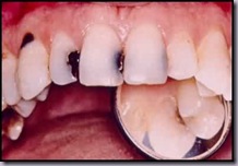 tooth-decay