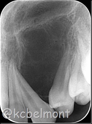 cisto periapical cisto periapical