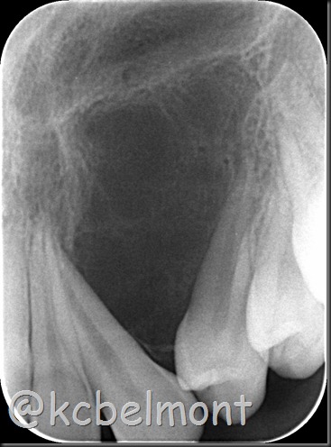 cisto periapical