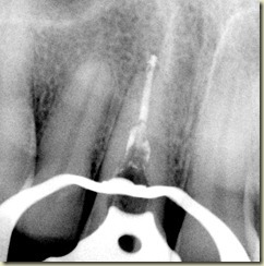 Internal Resorption SB apical gp010
