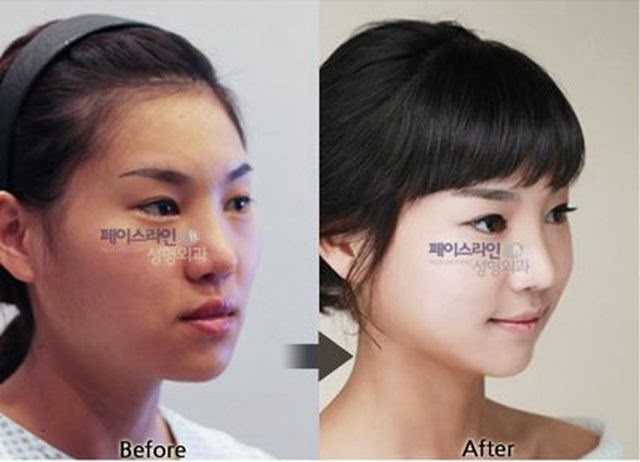 [korean-plastic-surgery-25%255B2%255D.jpg]