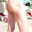 PsoriasisPunctata.JPG