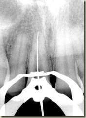 Internal Resorption SB file shot011