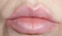 lips before using Kaplan MD Lip 20 Mask