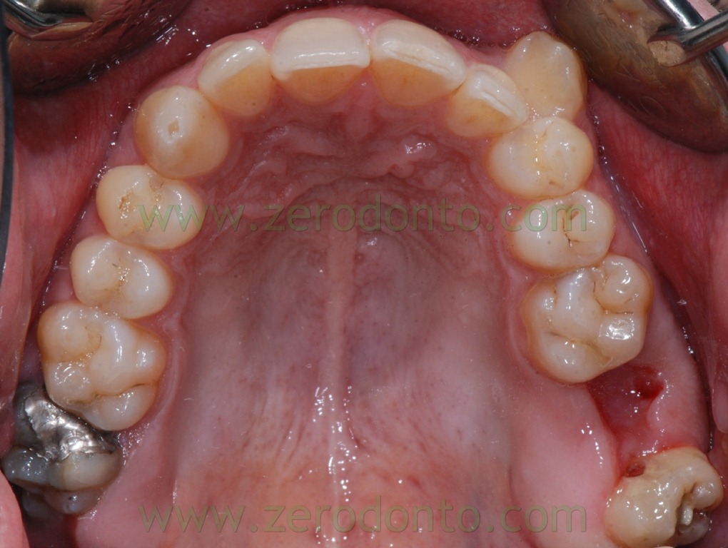 [10%2520estrazione%2520dente%255B2%255D.jpg]