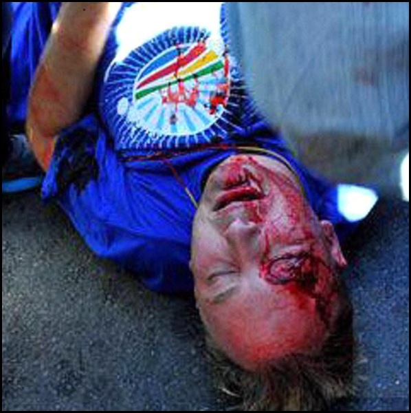DEMOCRATIC ALLIANCE MARCH MAY 15 2012 MAN INJURED BY BRICK Johannesburg