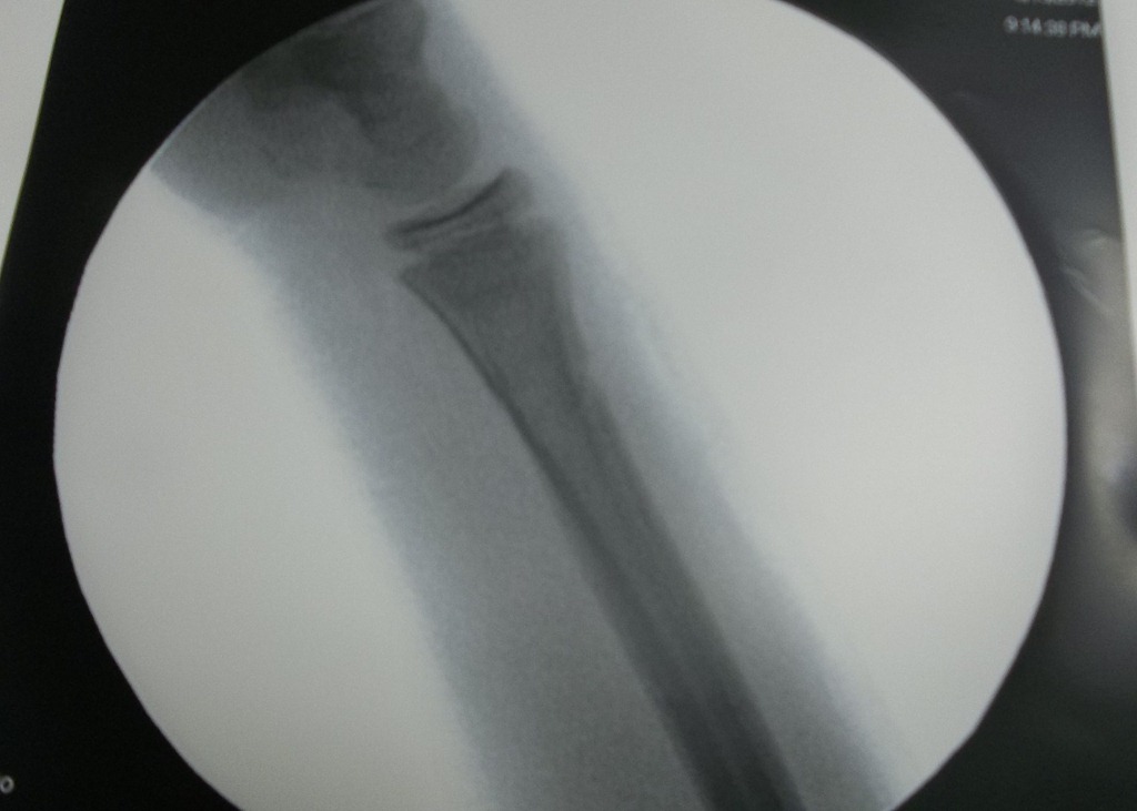 [brandons-broken-arm-0765.jpg]