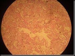 Lobar pneumonia high resolution histology slide tsnaps Lobar pneumonia high resolution histology slide tsnaps