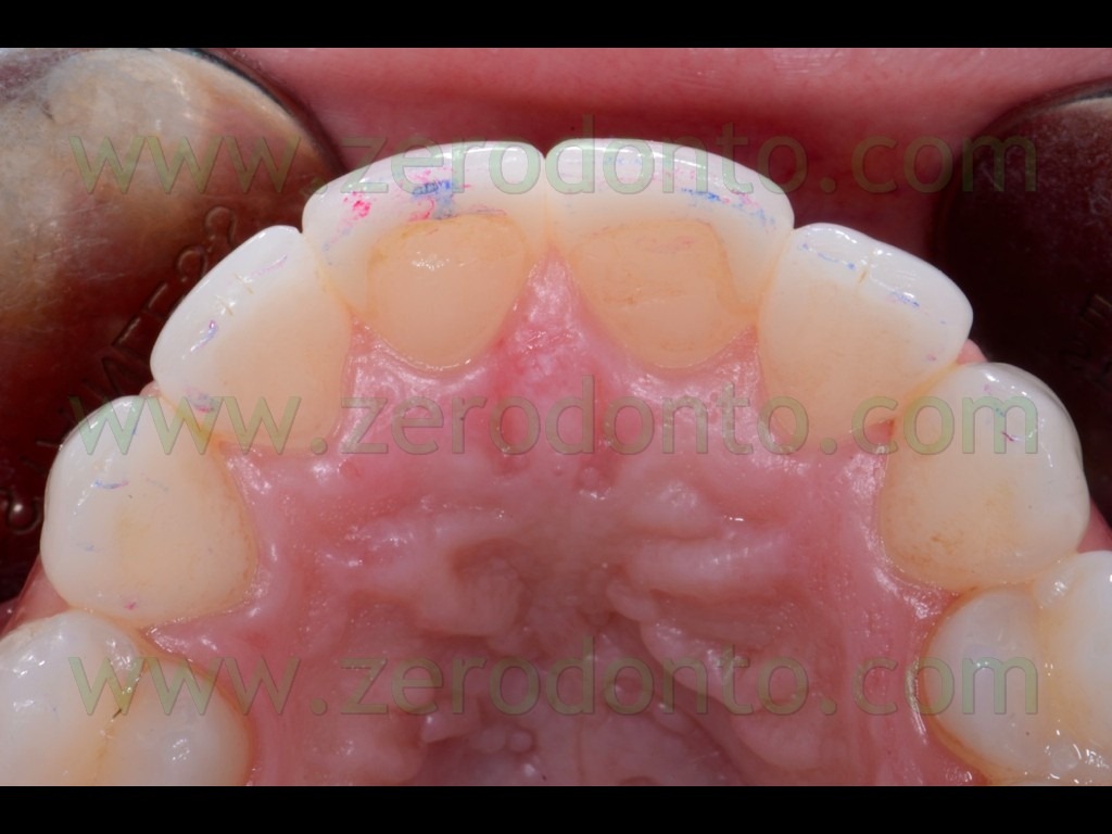 [124-controllo-occlusione-veneers2.jpg]