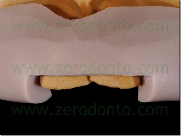 40 faccette indice silicone incisale