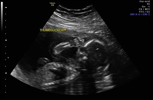 thumbsucker thumbsucker