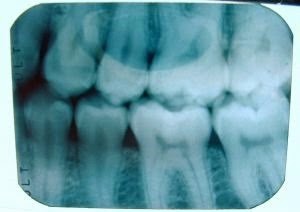 [teeth-x-ray-17763-m%255B4%255D.jpg]