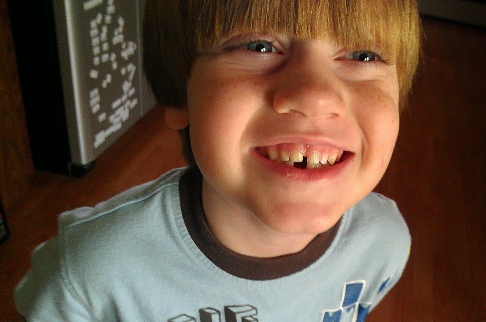 [Aikman%2520lost%2520tooth%255B6%255D.jpg]