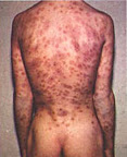 espalda-con-sifilis.jpg