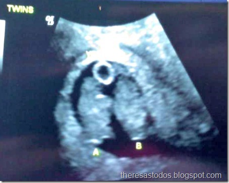 Twin Ultrasound